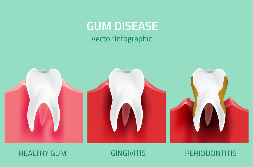 general dentistry practice w eric martin dds champaign il gum disease infographics