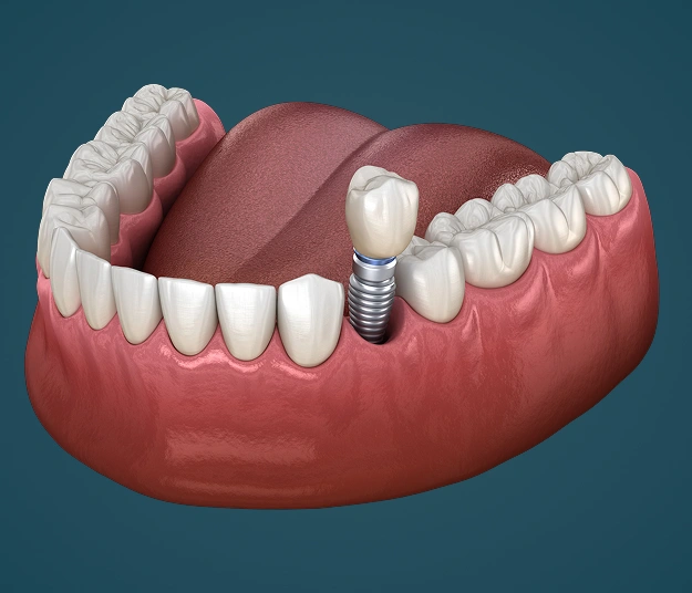 Dental Implant Replacing a Missing Tooth