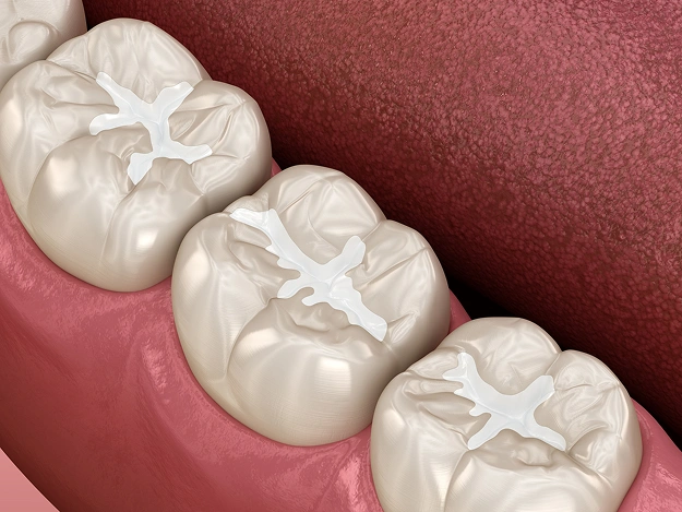 Protective Dental Sealant on Molar Teeth