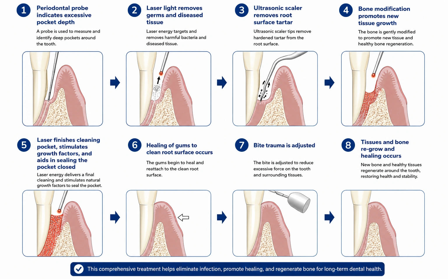 LANAP Treatment Procedure, Step by Step