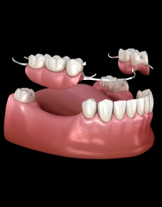 Partial denture for replacing missing teeth