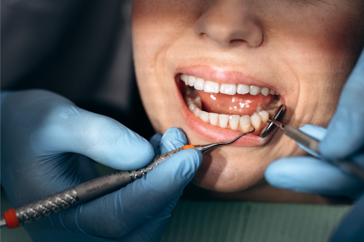 What Is the Best Antibiotic for Gum Infection